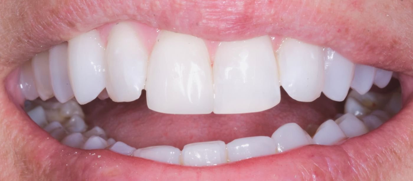 dent1-after (Custom)