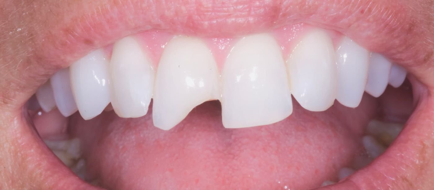 dent1-before (Custom)