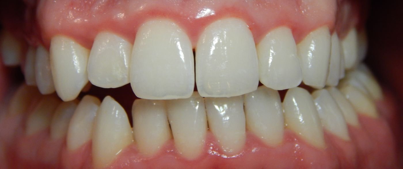 dent2-after (Custom)