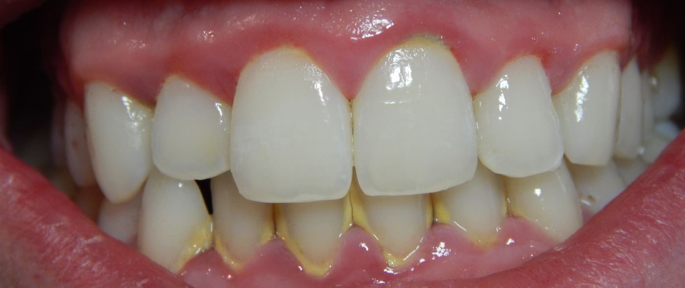 dent2-before (Custom)