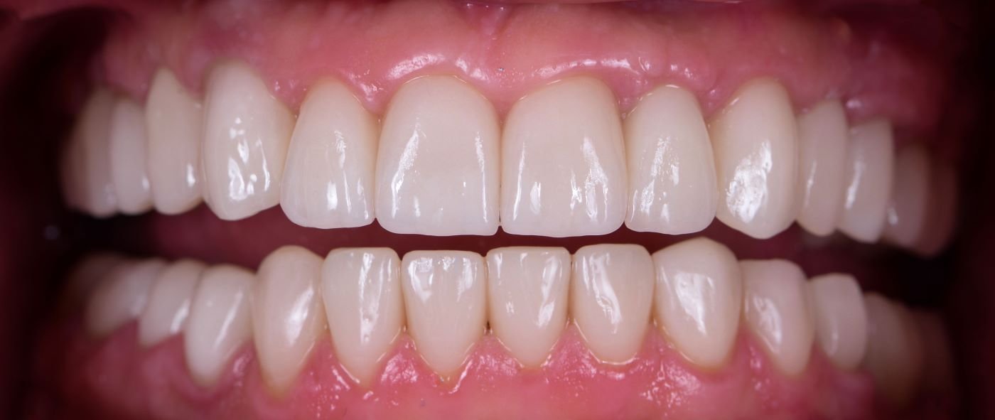 dent3-after (Custom)
