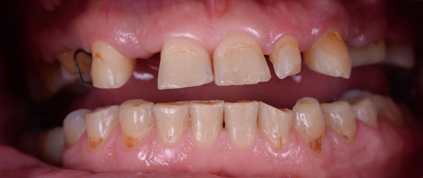 dent3-before (Custom)